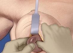Эндопротезирование с мастопексией